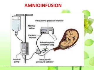 AMNIOINFUSION
 