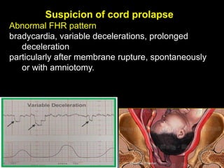 Suspicion of cord prolapse
Abnormal FHR pattern
bradycardia, variable decelerations, prolonged
deceleration
particularly after membrane rupture, spontaneously
or with amniotomy.
Aboubakr Elnashar
 