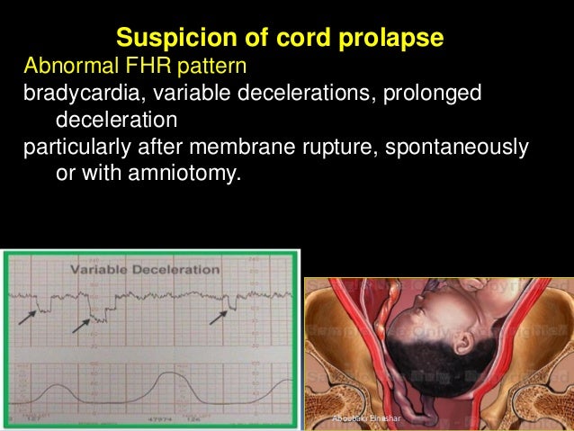 umbilical cord prolapse prolapsed cord