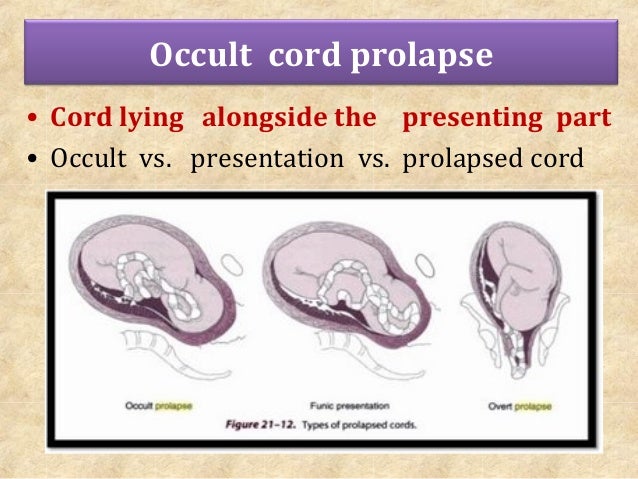 types of cord presentation