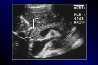 Posterior Float Normal CORE CURRICULUM LECTURE 06 NORMAL ABDOMINAL VESSELS.part 1.1.ppt
