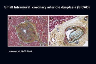 Small Intramural coronary arteriole dysplasia (SICAD)




  Kwon et al. JACC 2009
 