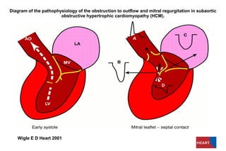 Diagram of the pathophysiology of the obstruction to outflow and mitral regurgitation in subaortic
                       obstructive hypertrophic cardiomyopathy (HCM).




   Wigle E D Heart 2001
 
