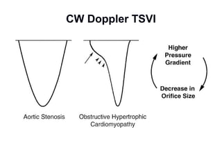 CW Doppler TSVI
 
