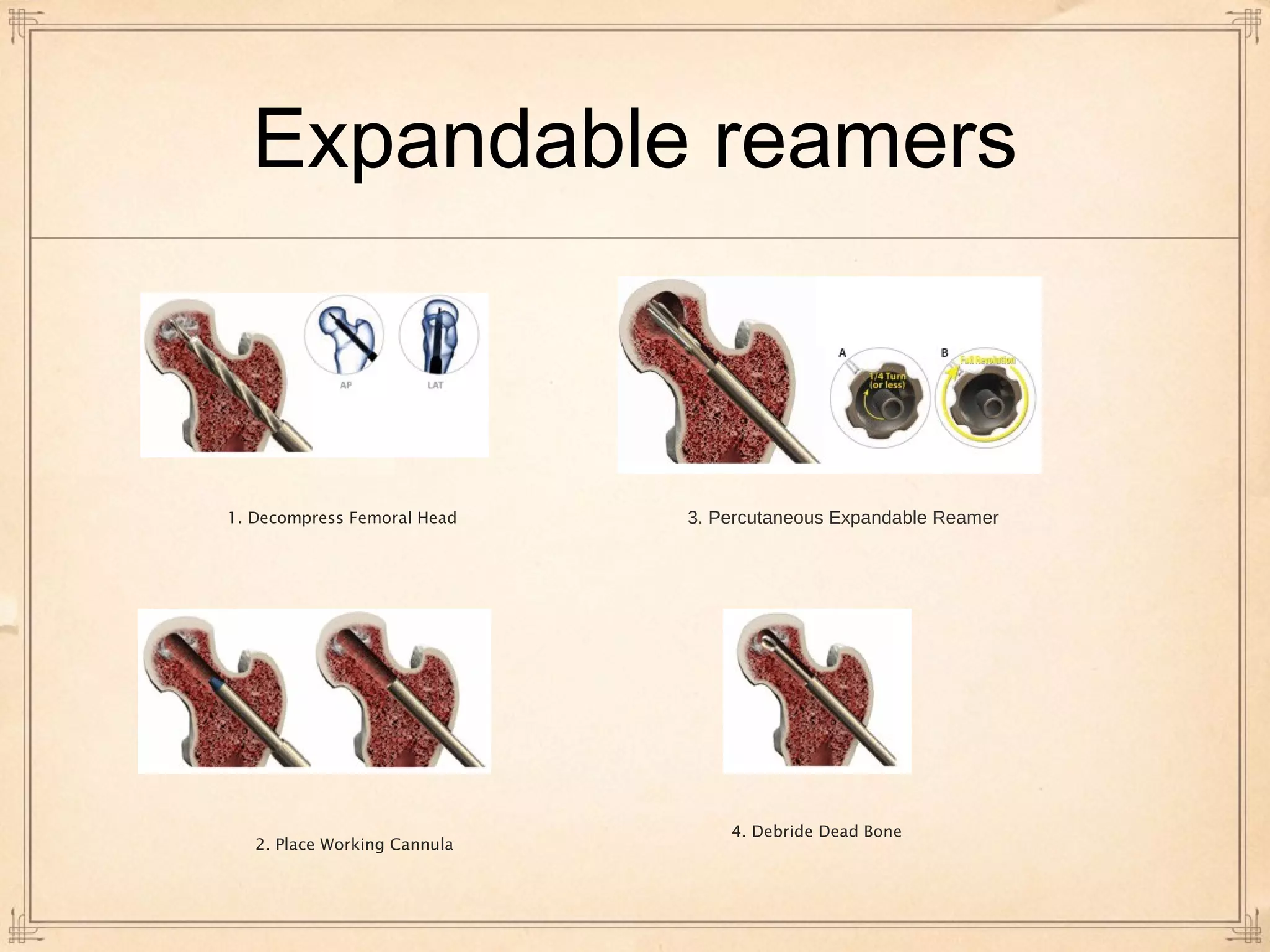 Expandable reamers 
1. Decompress Femoral Head 3. Percutaneous Expandable Reamer 
2. Place Working Cannula 
4. Debride Dead Bone 
 
