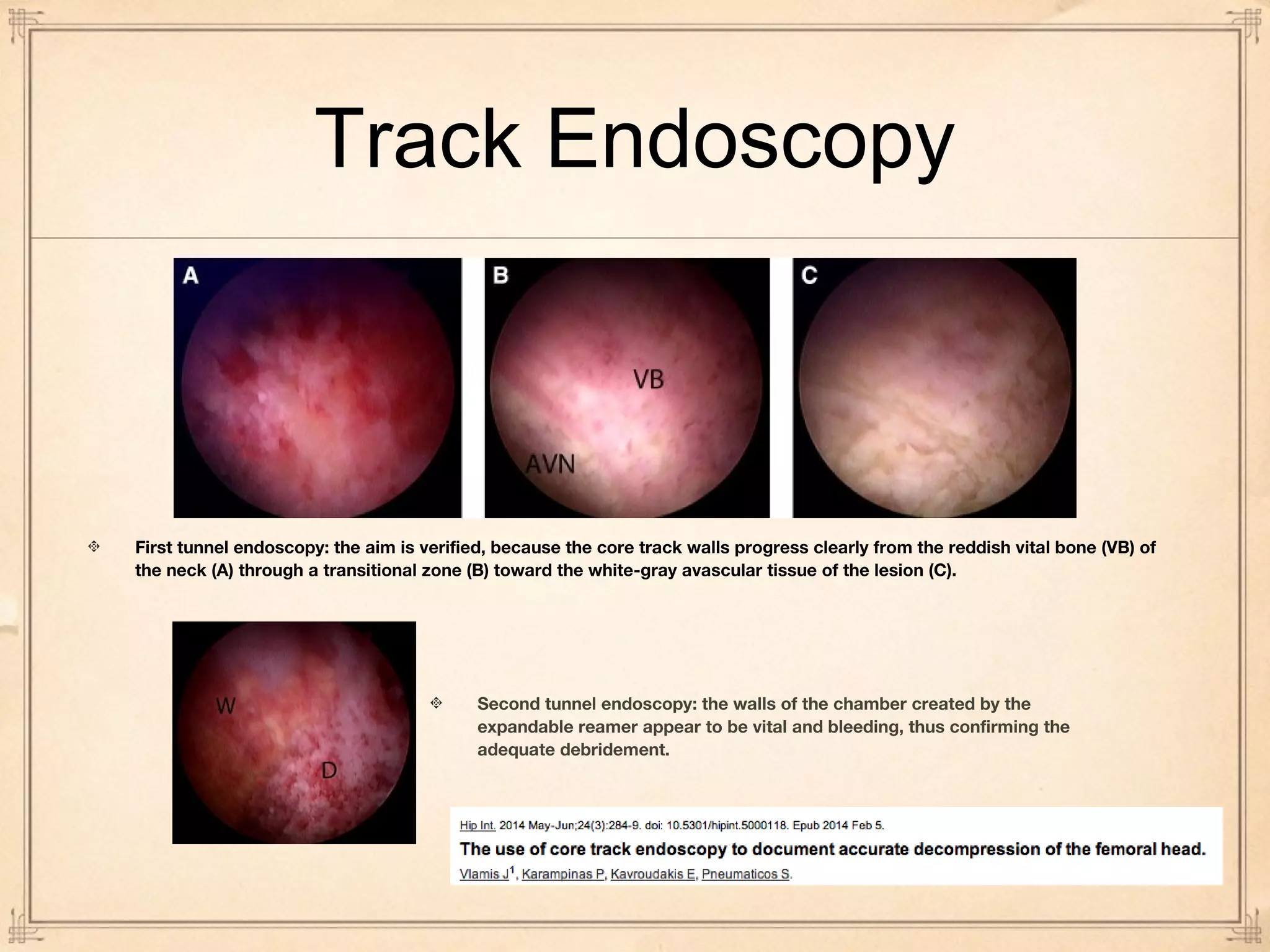 Track Endoscopy 
First tunnel endoscopy: the aim is verified, because the core track walls progress clearly from the reddish vital bone (VB) of 
the neck (A) through a transitional zone (B) toward the white-gray avascular tissue of the lesion (C). 
Second tunnel endoscopy: the walls of the chamber created by the 
expandable reamer appear to be vital and bleeding, thus confirming the 
adequate debridement. 
 