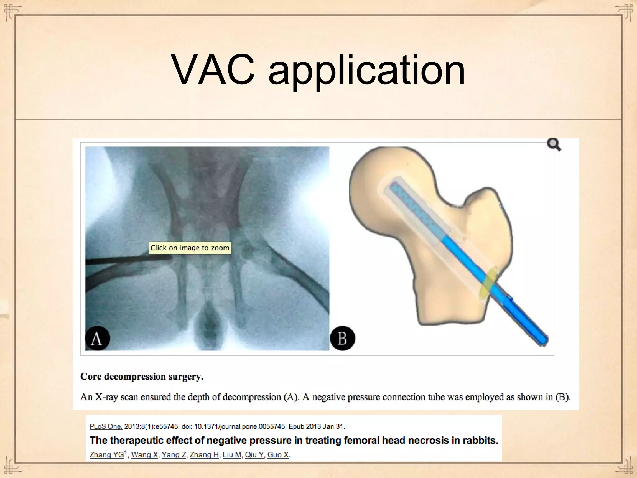 VAC application 
 