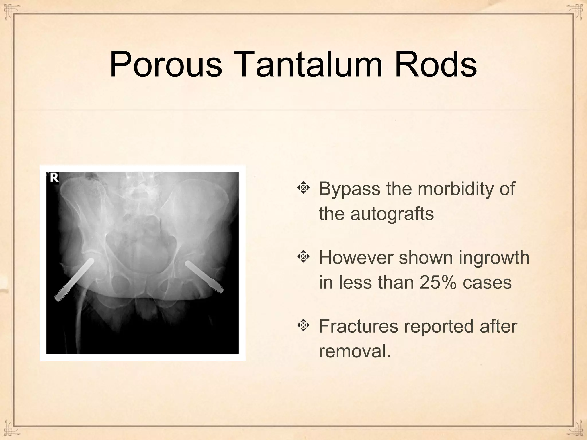 Porous Tantalum Rods 
Bypass the morbidity of 
the autografts 
However shown ingrowth 
in less than 25% cases 
Fractures reported after 
removal. 
 