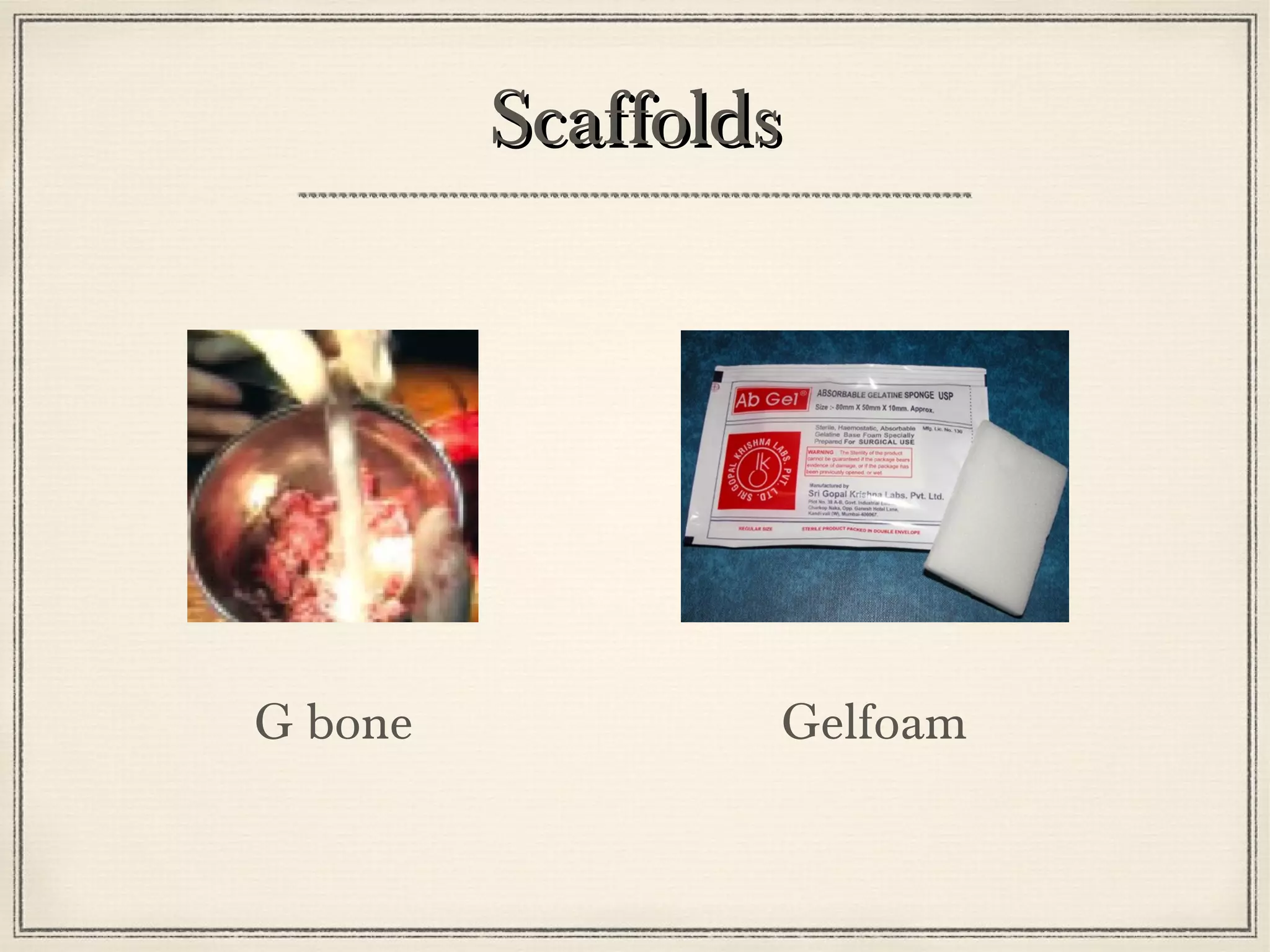 SSccaaffffoollddss 
G bone Gelfoam 
 