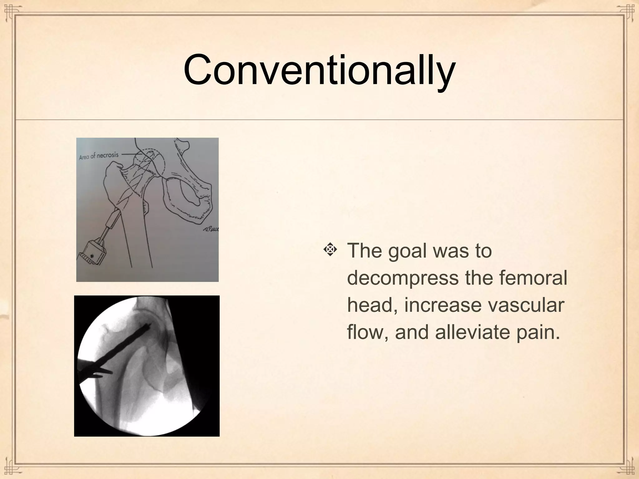 Conventionally 
The goal was to 
decompress the femoral 
head, increase vascular 
flow, and alleviate pain. 
 