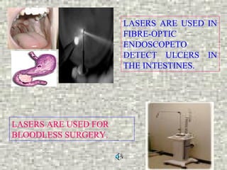 LASERS ARE USED IN
                      FIBRE-OPTIC
                      ENDOSCOPETO
                      DETECT ULCERS IN
                      THE INTESTINES.




LASERS ARE USED FOR
BLOODLESS SURGERY.
 