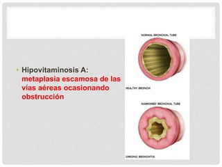 • Hipovitaminosis A:
metaplasia escamosa de las
vías aéreas ocasionando
obstrucción
 