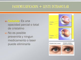  Catarata: Es una
opacidad parcial o total
de cristalino
 No es posible
prevenirla y ningun
medicamento o laser
puede eliminarla
 
