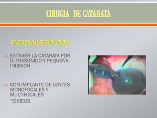 FACOEMULSIFICACION
 EXTRAER LA CATARATA POR
ULTRASONIDO Y PEQUEÑA
INCISION
 CON IMPLANTE DE LENTES
MONOFOCALES Y
MULTIFOCALES
TORICOS
 
