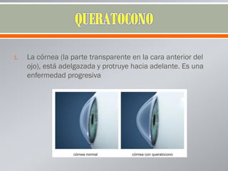 1. La córnea (la parte transparente en la cara anterior del
ojo), está adelgazada y protruye hacia adelante. Es una
enfermedad progresiva
 
