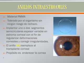  Material PMMA
 Tolerado por el organismo sin
ningún riesgo de rechazo.
 Implantar uno o dos segmentos
semicirculares espesor variable en
estroma corneal con el fin de
regularizar deformaciones
corneales y corregir irregularidades.
 El anillo NO reemplaza al
transplante corneal
 Propósito es enderezar la cornea
,
 