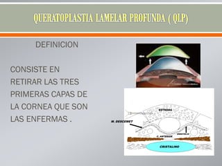 DEFINICION
CONSISTE EN
RETIRAR LAS TRES
PRIMERAS CAPAS DE
LA CORNEA QUE SON
LAS ENFERMAS .
ESTROMA
M. DESCEMET
C. ANTERIOR
ENDOTELIO
CRISTALINO
 