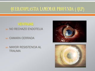 VENTAJAS
 NO RECHAZO ENDOTELIA
 CAMARA CERRADA
 MAYOR RESISTENCIA AL
TRAUMA
 