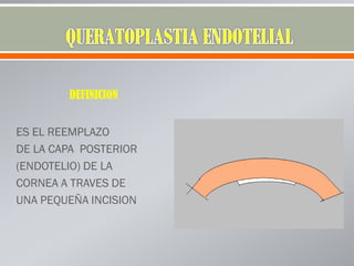 DEFINICION
ES EL REEMPLAZO
DE LA CAPA POSTERIOR
(ENDOTELIO) DE LA
CORNEA A TRAVES DE
UNA PEQUEÑA INCISION
 