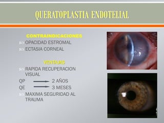 CONTRAINDICACIONES
 OPACIDAD ESTROMAL
 ECTASIA CORNEAL
VENTAJAS
 RAPIDA RECUPERACION
VISUAL
QP 2 AÑOS
QE 3 MESES
 MAXIMA SEGURIDAD AL
TRAUMA
 