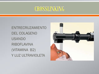 ENTRECRUZAMIENTO
DEL COLAGENO
USANDO
RIBOFLAVINA
(VITAMINA B2)
Y LUZ ULTRAVIOLETA
 