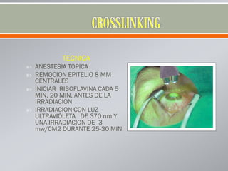 TECNICA
 ANESTESIA TOPICA
 REMOCION EPITELIO 8 MM
CENTRALES
 INICIAR RIBOFLAVINA CADA 5
MIN. 20 MIN. ANTES DE LA
IRRADIACION
 IRRADIACION CON LUZ
ULTRAVIOLETA DE 370 nm Y
UNA IRRADIACION DE 3
mw/CM2 DURANTE 25-30 MIN
 