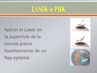 Aplicar el Laser en
la superficie de la
cornea previo
levantamiento de un
flap epitelial
 