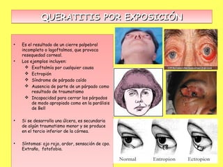 QUERATITIS POR EXPOSICIÓN


•   Es el resultado de un cierre palpebral
    incompleto o lagoftalmos, que provoca
    resequedad corneal.
•   Los ejemplos incluyen:
       Exoftalmía por cualquier causa
       Ectropión
       Síndrome de párpado caído
       Ausencia de parte de un párpado como
         resultado de traumatismo
       Incapacidad para cerrar los párpados
         de modo apropiado como en la parálisis
         de Bell

•   Si se desarrolla una úlcera, es secundaria
    de algún traumatismo menor y se produce
    en el tercio inferior de la córnea.

•   Síntomas: ojo rojo, ardor, sensación de cpo.
    Extraño, fotofobia.
 