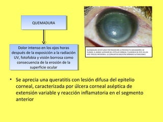 QUEMADURA
            QUEMADURA




    Dolor intenso en los ojos horas
     Dolor intenso en los ojos horas      QUEMADURA ACENTUADA POR RADIACIÓN ULTRAVIOLETA (SOLDADORES DE
después de la exposición aala radiación
 después de la exposición la radiación    PLOMO). EL BORDE SUPERIOR DEL EPITELIO CORNEAL Y AUSENCIA DE ÉSTE EN LOS
                                          DOS TERCIOS INFERIORES. LA CONJUNTIVA MUESTRA MÍNIMAS ALTERACIONES

 UV, fotofobia yyvisión borrosa como
  UV, fotofobia visión borrosa como
   consecuencia de la erosión de la
    consecuencia de la erosión de la
            superficie ocular
             superficie ocular


• Se aprecia una queratitis con lesión difusa del epitelio
  corneal, caracterizada por úlcera corneal aséptica de
  extensión variable y reacción inflamatoria en el segmento
  anterior
 