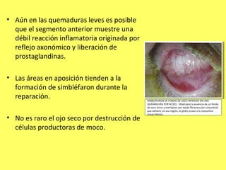 • Aún en las quemaduras leves es posible
  que el segmento anterior muestre una
  débil reacción inflamatoria originada por
  reflejo axonómico y liberación de
  prostaglandinas.

• Las áreas en aposición tienden a la
  formación de simbléfaron durante la
  reparación.                                 SIMBLÉFARON DE FONDO DE SACO INFERIOR EN UNA
                                              QUEMADURA POR ÁCIDO. Obsérvese la ausencia de un fondo
                                              de saco único y reemplazo por tejido fibrovascular conjuntival
                                              que adhiere, en esa región, el globo ocular a la conjuntiva
                                              tarsal inferior.
• No es raro el ojo seco por destrucción de
  células productoras de moco.
 