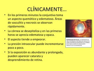 CLÍNICAMENTE…
• En los primeros minutos la conjuntiva toma
  un aspecto quemótico y edematoso. Áreas
  de vasculitis y necrosis se observan
  rápidamente.
• La córnea se desepiteliza y en las primeras
  horas se aprecia edematosa y opaca.
• El aspecto tiende a empeorar.                 QUEMADURA POR ÁLCALI. LA CONJUNTIVA SE
                                                HALLA HIPERÉMICA CON ÁREAS DE VASCULITIS Y
                                                ZONAS ISQUÉMICAS ALREDEDOR DE LA CÓRNEA.
• La presión intraocular puede incrementarse    ÉSTA TIENE UN ASPECTO OPALESCENTE
                                                PRODUCTO DE LA QUEMADURA.

  poco a poco.
• Si la exposición es abundante y prolongada,
  pueden aparecer catarata y
  desprendimiento de retina.
 