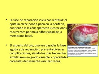 • La fase de reparación inicia con lentitud: el
  epitelio crece poco a poco en la periferia,
  cubriendo la lesión; aparecen ulceraciones
  recurrentes por mala adhesividad de la
  membrana basal.

• El aspecto del ojo, una vez pasadas la fase     SECUELA DE UNA QUEMADURA POR ÁLCALI.

  aguda y de reparación, presenta diversas        SIMBLÉFARON QUE ADHIERE LA CONJUNTIVA TARSAL
                                                  SUPERIOR A LA CONJUNTIVA BULBAR. UNA LESIÓN ASÍ
                                                  LIMITA EL MOVIMIENTO DEL OJO Y ALTERA LA
  complicaciones, siendo las más frecuentes       LUBRICACIÓN SUPERFICIAL POR OBLITERACIÓN DE LAS
                                                  GLÁNDULAS LAGRIMALES.

  simbléfaron en grado variable y opacidades
  corneales densamente vascularizadas.
 
