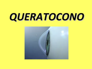 QUERATOCONO
 