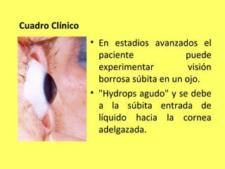 Cuadro Clínico
                 • En estadios avanzados el
                   paciente             puede
                   experimentar          visión
                   borrosa súbita en un ojo.
                 • "Hydrops agudo" y se debe
                   a la súbita entrada de
                   líquido hacia la cornea
                   adelgazada.
 