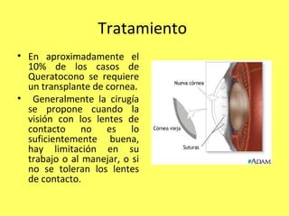 Tratamiento
• En aproximadamente el
  10% de los casos de
  Queratocono se requiere
  un transplante de cornea.
• Generalmente la cirugía
  se propone cuando la
  visión con los lentes de
  contacto no es lo
  suficientemente buena,
  hay limitación en su
  trabajo o al manejar, o si
  no se toleran los lentes
  de contacto.
 