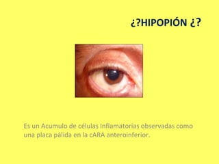 ¿?HIPOPIÓN ¿?




Es un Acumulo de células Inflamatorias observadas como
una placa pálida en la cARA anteroinferior.
 