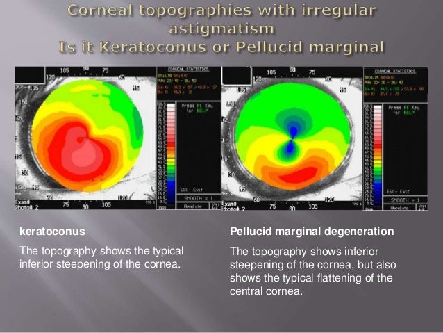 Common Cases: Cornea