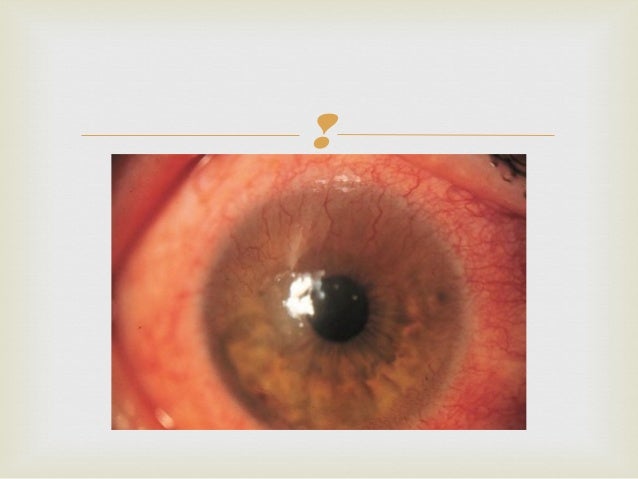 Diseases of the Cornea