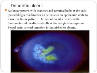 Linear Vesicles Cornea | PPT