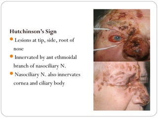 Hutchinson’s Sign
Lesions at tip, side, root of
nose
Innervated by ant ethmoidal
branch of nasociliary N.
Nasociliary N. also innervates
cornea and ciliary body
 