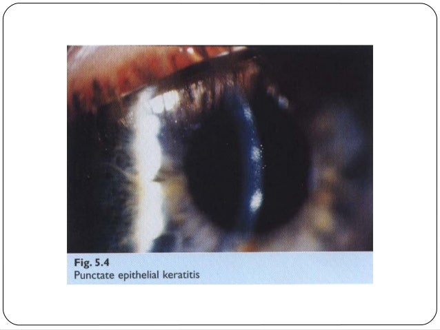 Keratoconjunctivitis Sicca Corneal Epithelial Hop Contoh