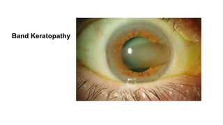 Band Keratopathy
 