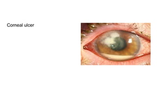 Corneal ulcer
 
