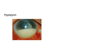 Hypopyon
 