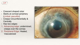 Cornea 2 | PPTX