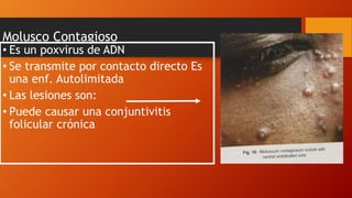 Molusco Contagioso
• Es un poxvirus de ADN
• Se transmite por contacto directo Es
una enf. Autolimitada
• Las lesiones son:
• Puede causar una conjuntivitis
folicular crónica
 