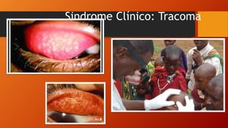 Sindrome Clínico: Tracoma
 