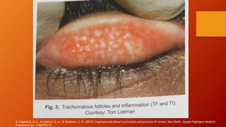 In Copeland, R. A., In Afshari, N. A., & Dohlman, C. H. (2013). Copeland and Afshari's principles and practice of cornea. New Delhi: Jaypee-Highlights Medical
Publishers, Inc. CHAPTER 27.
 
