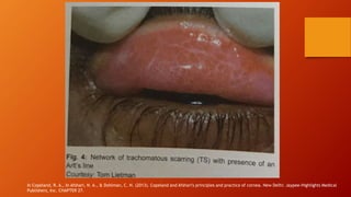 In Copeland, R. A., In Afshari, N. A., & Dohlman, C. H. (2013). Copeland and Afshari's principles and practice of cornea. New Delhi: Jaypee-Highlights Medical
Publishers, Inc. CHAPTER 27.
 