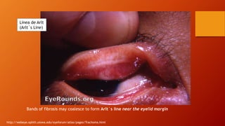Línea de Arlt
(Arlt´s Line)
Bands of fibrosis may coalesce to form Arlt´s line near the eyelid margin
http://webeye.ophth.uiowa.edu/eyeforum/atlas/pages/Trachoma.html
 